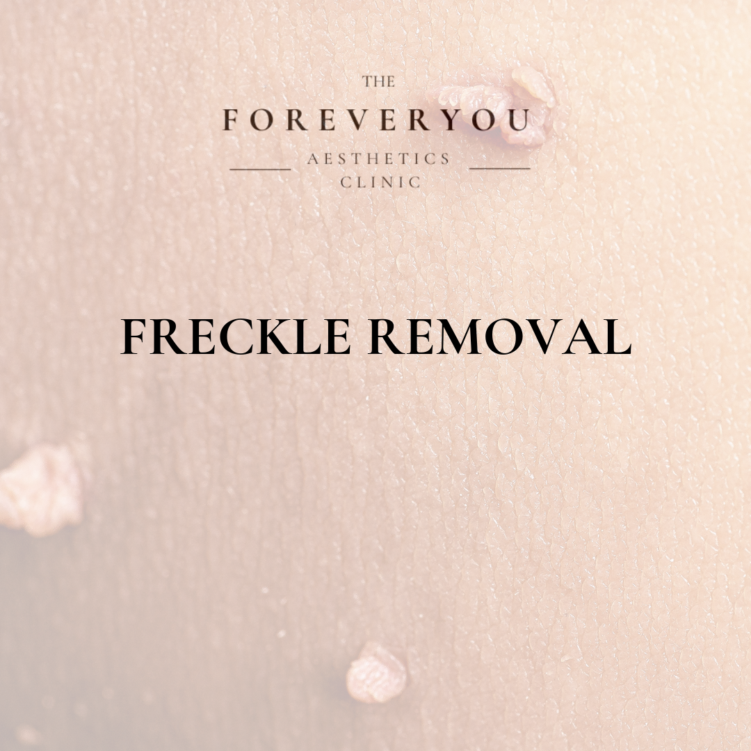 Freckle Removal