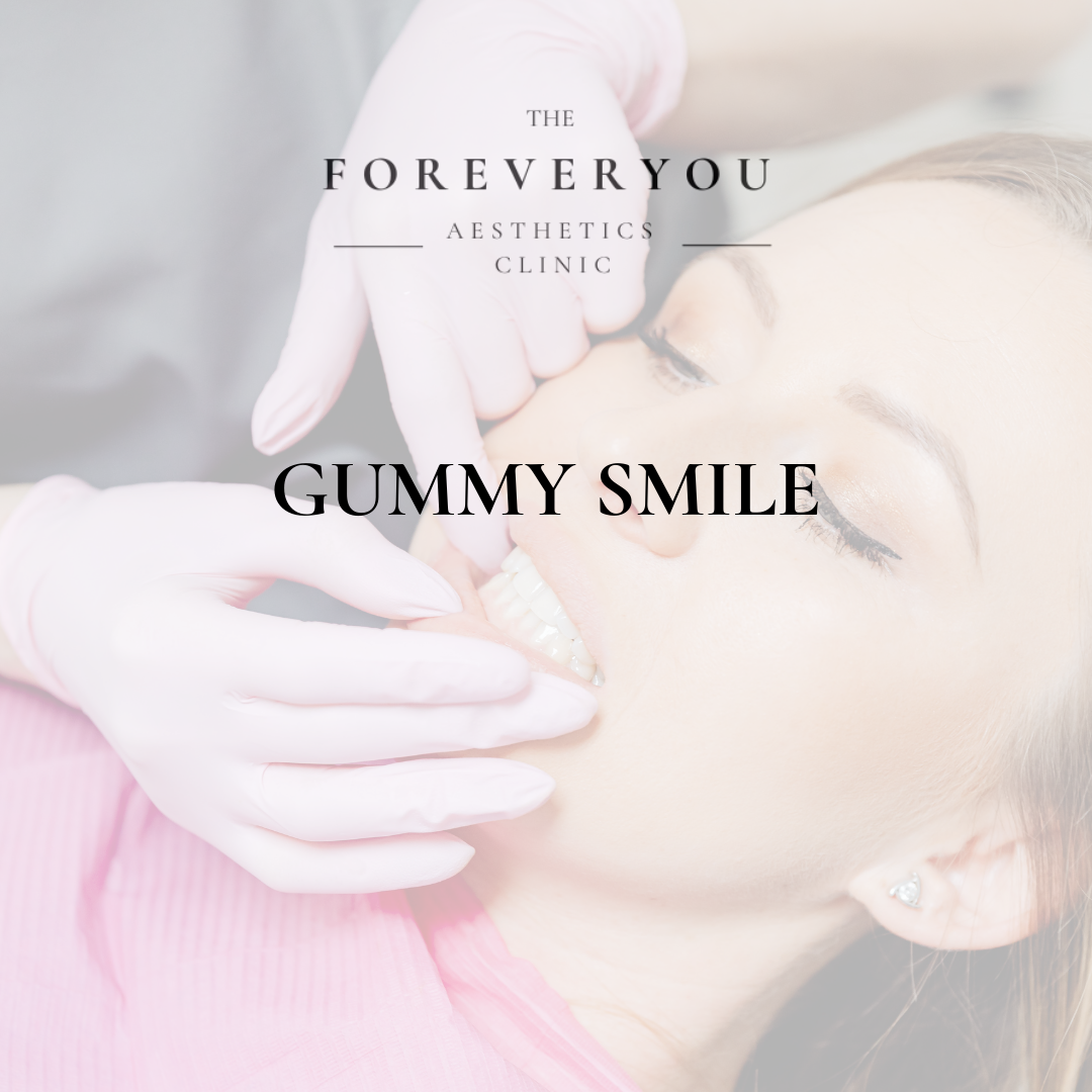 Gummy Smile