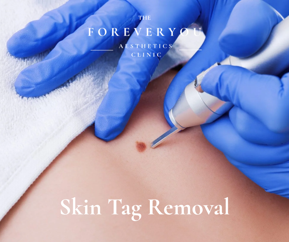 Skin Tag/ Mole Removal