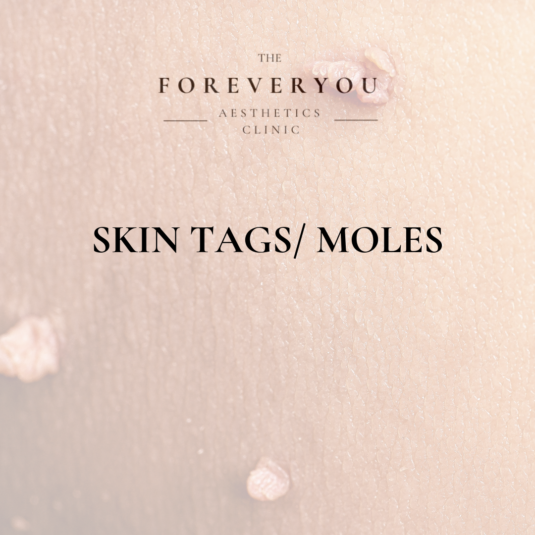 Skin Tag/Mole Removal