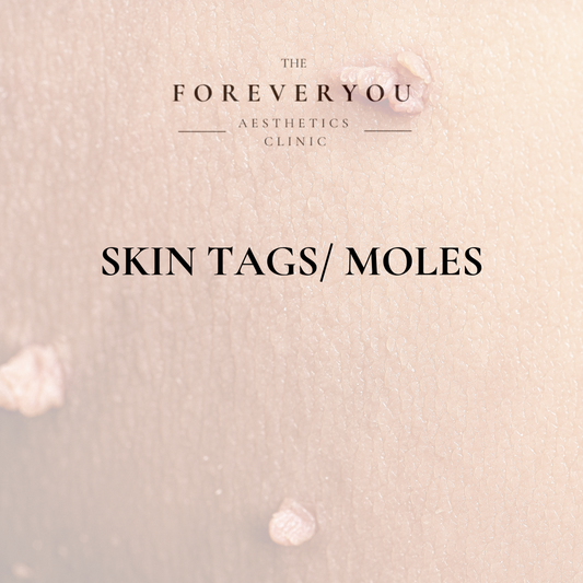 Skin Tag/Mole Removal